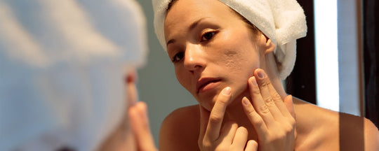 The Art of Acne-Free Skin: Skincare Routine for Beginners