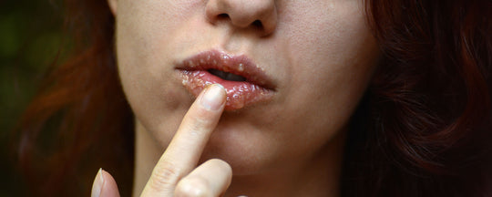 Cold Weather Lip Care : Home Remedies