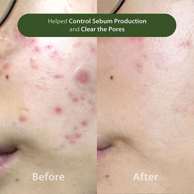 Before and After Results Using Blithe Pore Cleansing Foam BHA 0.5 for Controlling Sebum Production and Clearing Pores - Buy Online for Best Deals