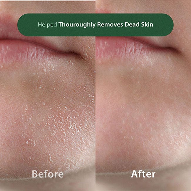 Before and After Results Using Blithe Pore Cleansing Foam BHA 0.5 for Effective Dead Skin Removal and Deep Pore Cleansing - Best Deals Available